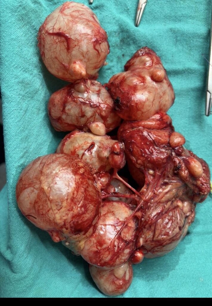 Uterine fibroid seen on pelvic ultrasound showing a well-defined uterine mass doctorexplain.org